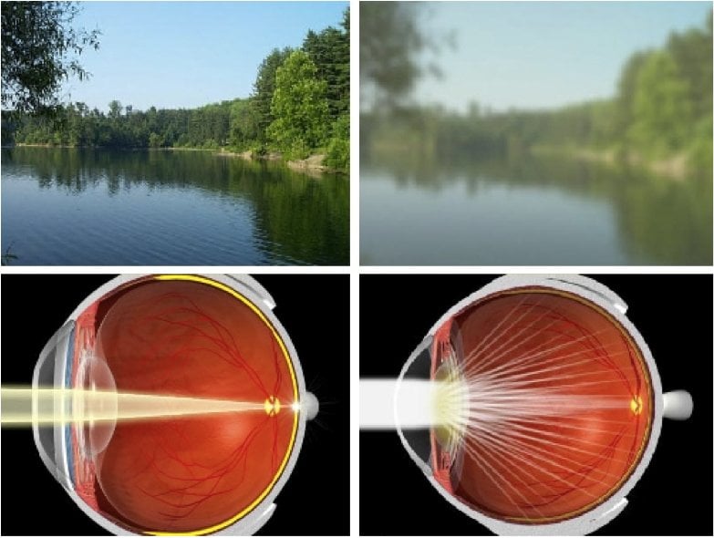 Видим б н. Катаракта глаукома астигматизм. Зрение при глаукоме и катаракте. Астигматизм изображение.