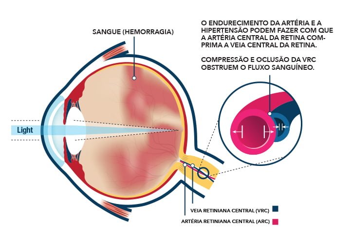 Olhos Inchados potenciais causas