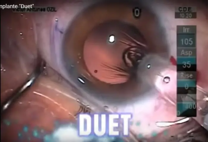 Vídeo: Cirurgia de Implante Multifocal M-Duet