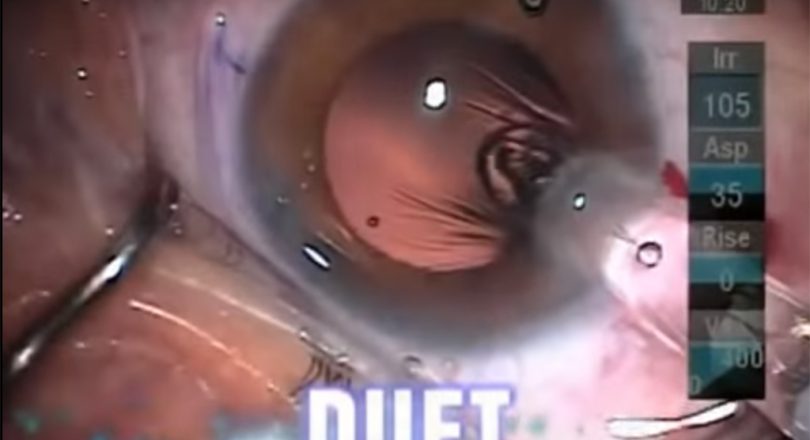 Vídeo: Cirurgia de Implante Multifocal M-Duet