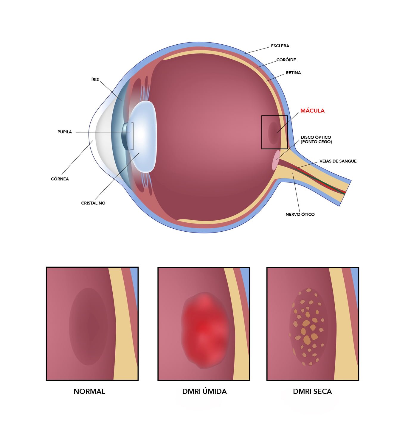 Tratamento da Retina - Instituto de Moléstias Oculares