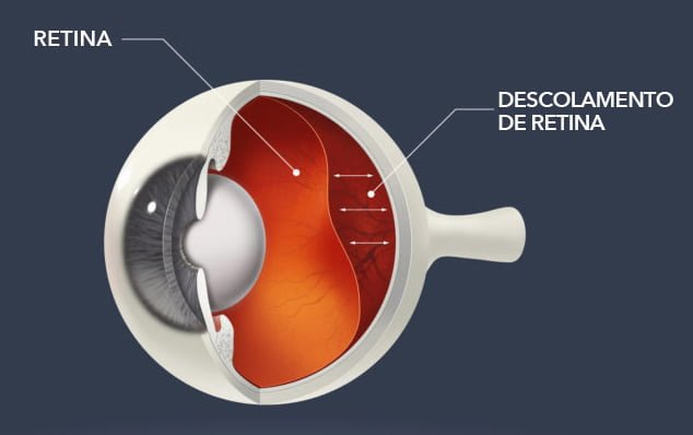 Descolamento de Retina - Instituto de Moléstias Oculares