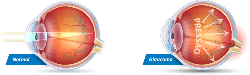 restaurarea vederii chirurgie glaucom