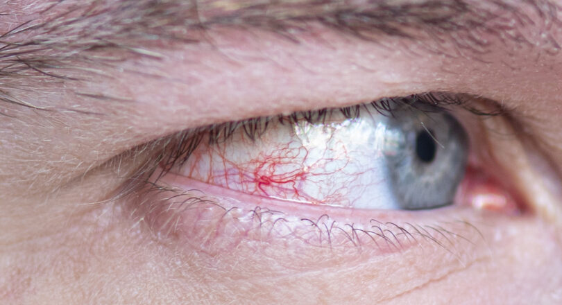 Os riscos do glaucoma de ângulo fechado