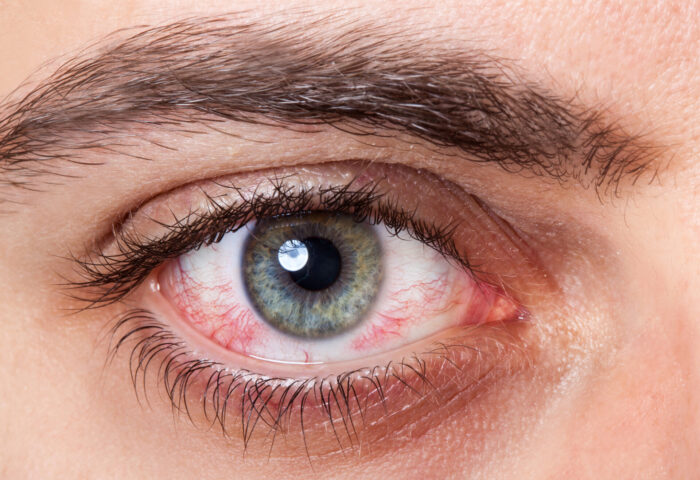 Julho Turquesa – Síndrome do Olho Seco