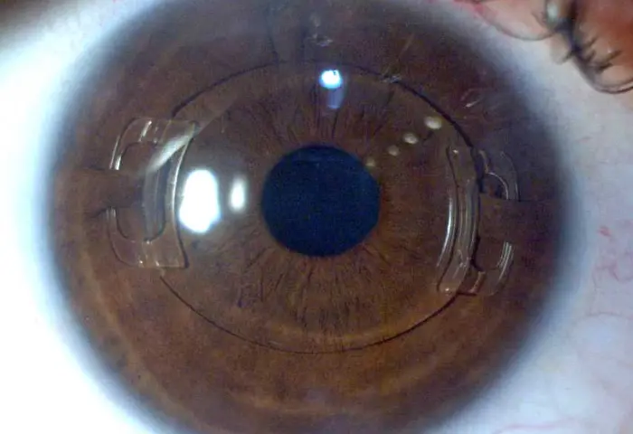 Lentes intraoculares fácicas: Quando são indicadas?