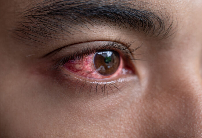 Tuberculose Ocular: Um Olhar Sobre os Sintomas e Tratamentos