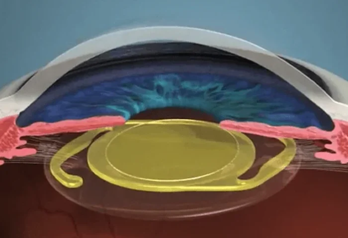 Dica do Especialista para Melhorar os Resultados das Lentes Premium na Cirurgia de Catarata