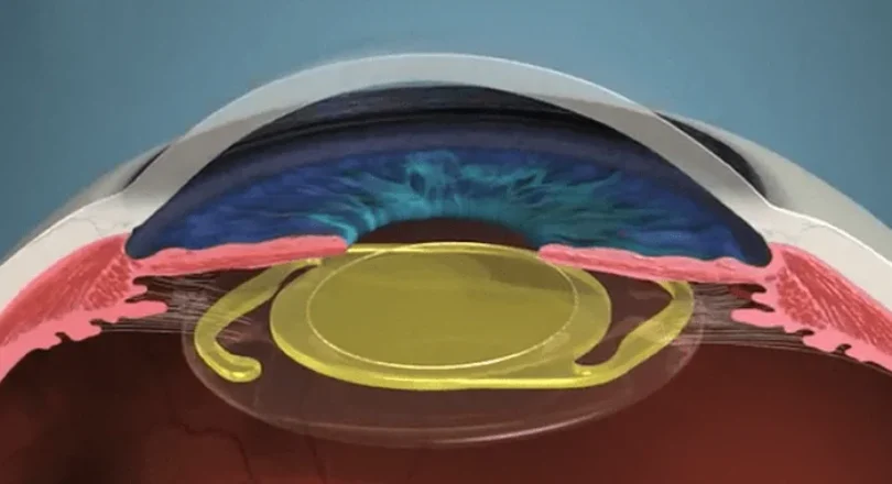 Dica do Especialista para Melhorar os Resultados das Lentes Premium na Cirurgia de Catarata